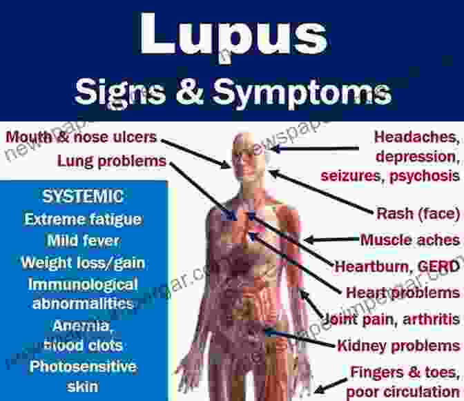 A Woman With Lupus Experiencing Pain And Fatigue Psychologic Services For Patients With Systemic Lupus Erythematosus