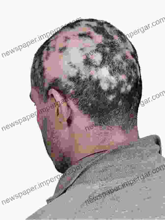 Alopecia Areata Bald Patches NUTRITION AND HAIR LOSS: A NEW PERSPECTIVE ON Male Pattern Baldness Telogen Effluvium Alopecia Areata