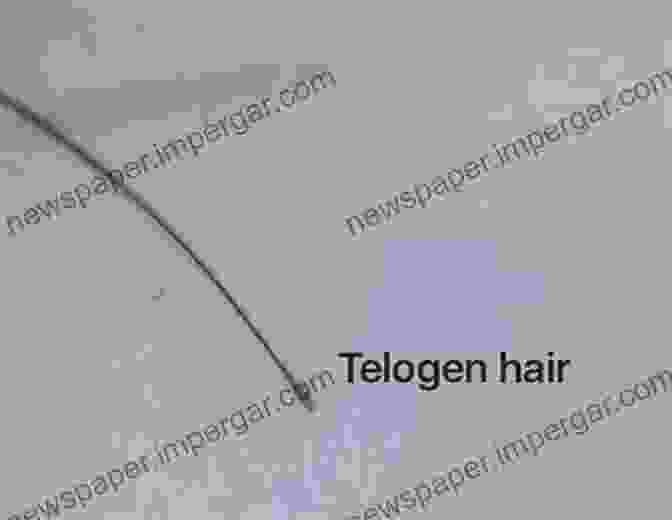 Telogen Effluvium Hair Shedding NUTRITION AND HAIR LOSS: A NEW PERSPECTIVE ON Male Pattern Baldness Telogen Effluvium Alopecia Areata