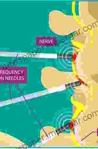 Essentials of Radiofrequency Ablation of the Spine and Joints