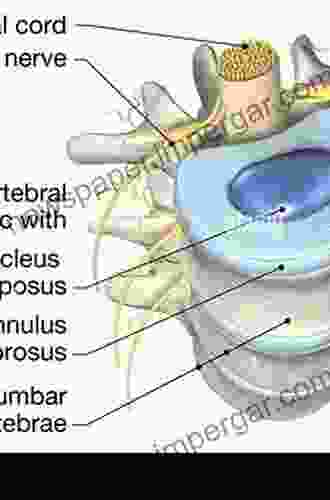 Lumbar Intervertebral Disc John Frame