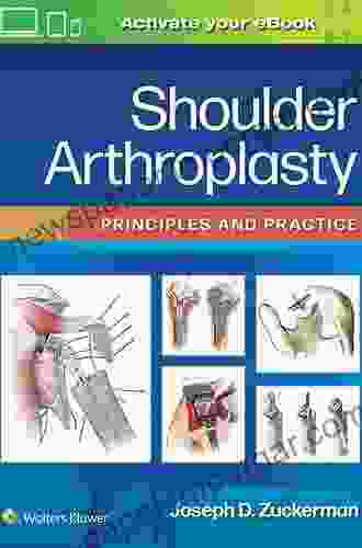 Shoulder Arthroplasty: Principles And Practice