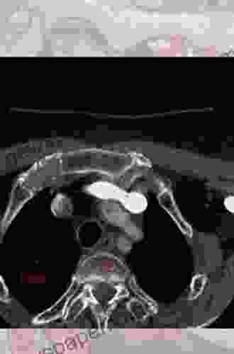 Atlas Of CT Angiography: Normal And Pathologic Findings