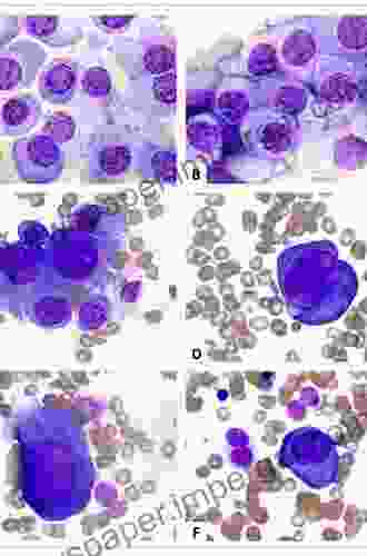 Multiple Myeloma And Other Plasma Cell Neoplasms (Hematologic Malignancies 0)